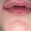 Brufolo sul labbro dopo acido ialuronico? - 19878