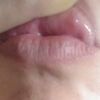 Pallina bluastro interno labbro superiore post filler labbra - 19887