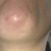 Filler acido ialuronico mento