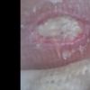 Ulcera in seguito a mastoplastica? - 19921