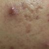 Come eliminare cicatrici su pelle olivastra