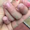 Tratamento contro iperidrosi