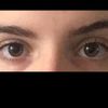 Asimmetria zona occhi