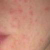 Pillola può provocare acne? - 20043