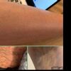 Epilazione laser alessandrite Deka Motus AX