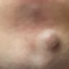 Come trattare la cicatrice dopo l'asportazione chirurgica di un nevo congenito?