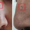 Trattamento vecchia cicatrice atrofica naso causata da diatermocoagulazione - 20120
