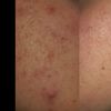 Trattamento macchie post acne aiuto - 20123