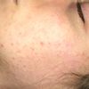 Pelle asfittica e acne, aiutatemi