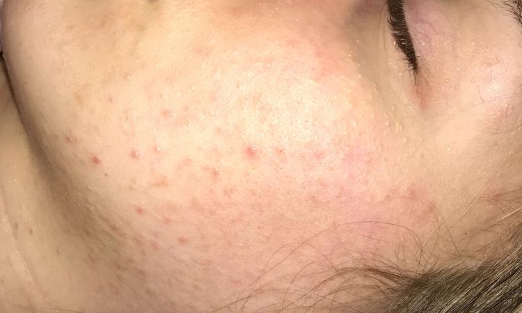 Pelle asfittica e acne, aiutatemi - 20153