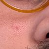 Cicatrice sul volto dopo laser vascolare? - 20245