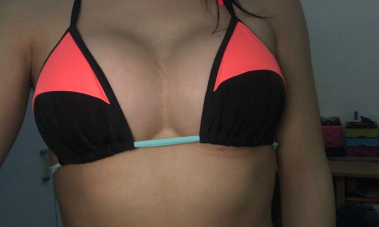 Si tratta di simmastia? Posso risolvere con un reggiseno apposito? - 20253