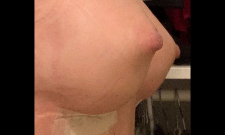 Areola gonfia post mastoplastica - 20352