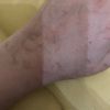 Cerco consigli per guarire le mie cicatrici