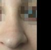 Cicatrice punta del naso post rinoplastica - 20365