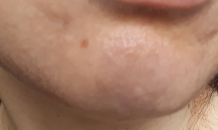 Dermatite dopo acido mandelico - 20394