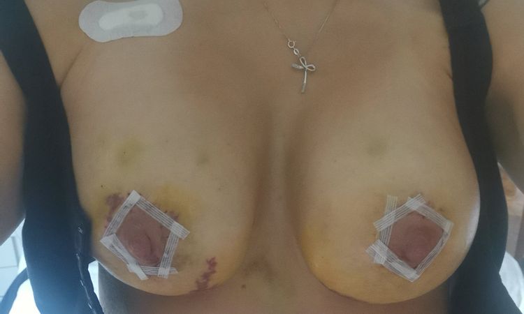 Ematoma post mastopessi con protesi - 20412