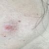 Infiltrazioni cortisone viso