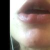 Cicatrice labbro dopo incidente - 20510