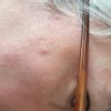 Cicatrice ipertrofica dopo DTC per cheratosi attinica - 20517