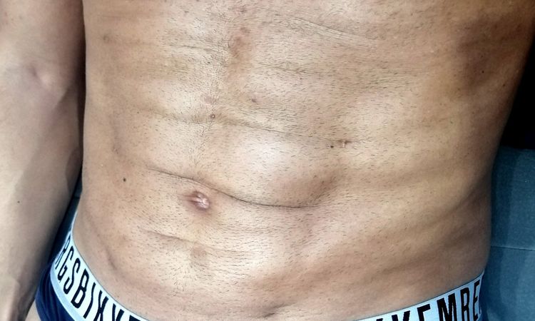 Vaserl liposuzione 4d post intervento problema fibrosi - 20527
