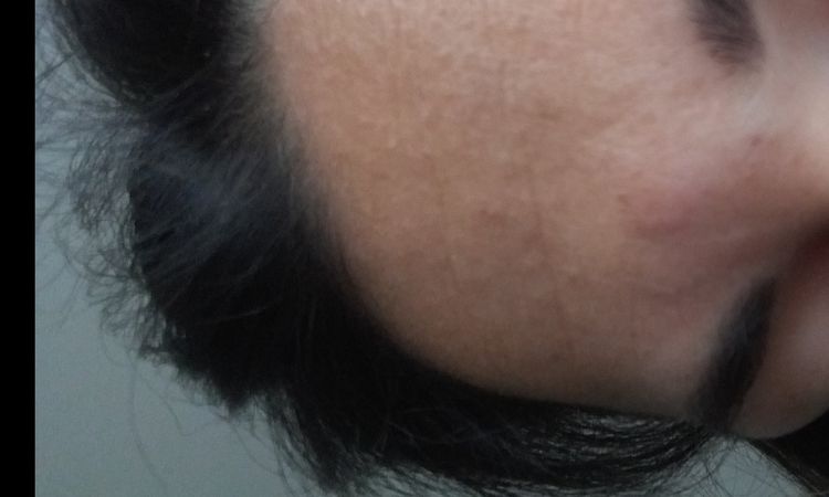 Post botox glabella gonfiore - 20552