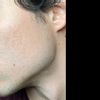 Risultati laser cicatrici post acne