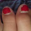 Problema unghie del piede - 20603