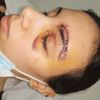 Cicatrice in fronte da ferita lacero-contusa sopraciliare - 20656