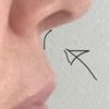 Rinoplastica - curvatura base del naso - 20686