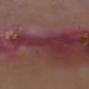 Guarigione cicatrice
