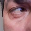 Gonfiore occhio blefaroplastica inferiore - 20785