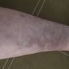 Ematoma non assorbito