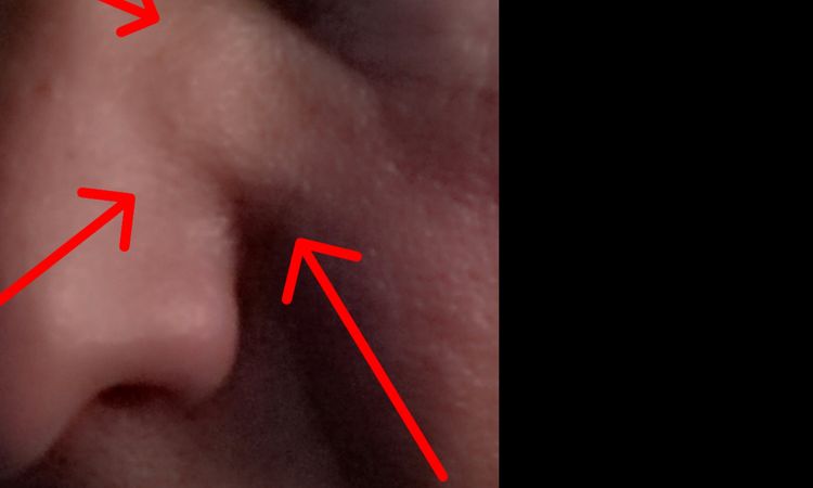 Gonfiore lato naso dopo 4 anni da Rino - 20860