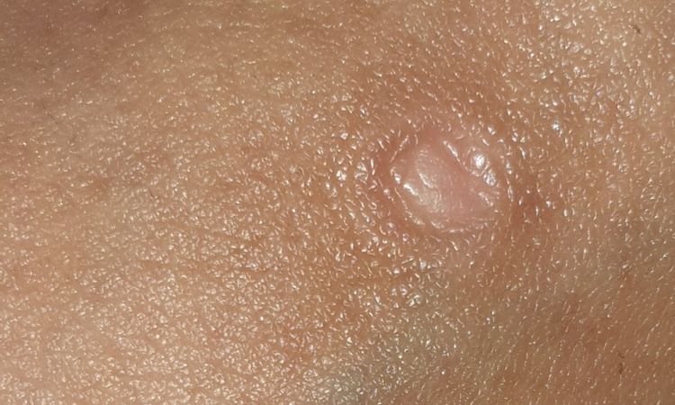 Cicatrice tonda sull' asta del pene - 20886