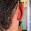 Pallina nel retro dell'orecchio dopo 6 mesi - 20900