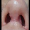 Rinoplastica cucitura sotto il naso fatta male - 20906
