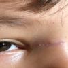 Cosa potrei/dovrei fare per migliorare la cicatrice di mio figlio di 5 anni? - 20909