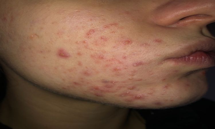 Acne con macchie persistenti - 20966