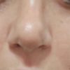 Solchi sulla punta del naso dopo rinosettoplastica - 20973