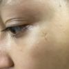 Cicatrice sul viso di una bambina di 13 anni - 20991