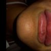 Filler labbra venuto male