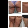 Cellulite, pelle flaccida e in accesso