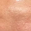 Laser cicatrici acne - 21028