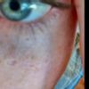 Cicatrice cisti sotto occhio - 21055