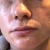 Trattamento segni post acneici