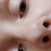 Rinoplastica correzione punta del naso - 21102