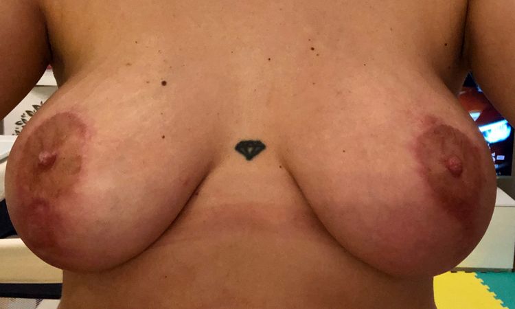 Mastopessi con protesi da ritoccare? - 21142