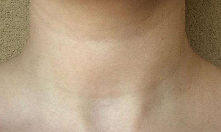 Rughe sul collo, collana di venere - 21148