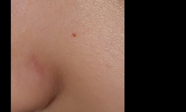 È comparso un neo rosso sul viso della bambina - 21149